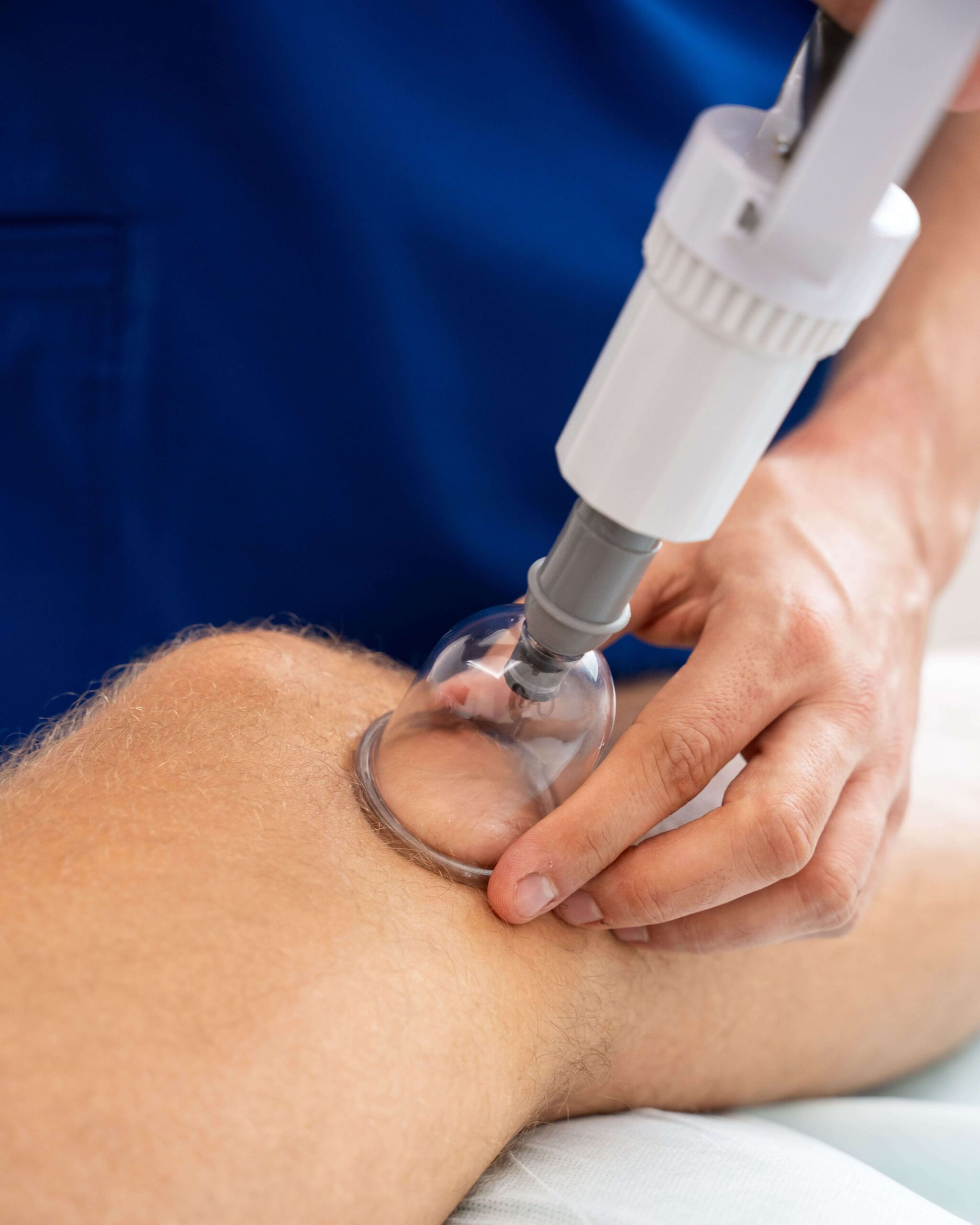 Sesión de cupping therapy (terapia con ventosas) en FisioSinergia, Teatinos (Málaga)