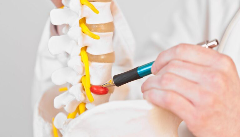 Hernia discal lumbar - Málaga