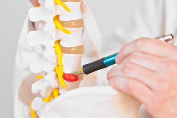 Hernia discal lumbar - Málaga