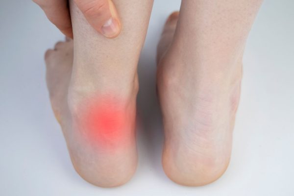 Tratamiento para la Tendinopatía Aquílea - Clínica de Fisioterapia en Teatinos - Málaga
